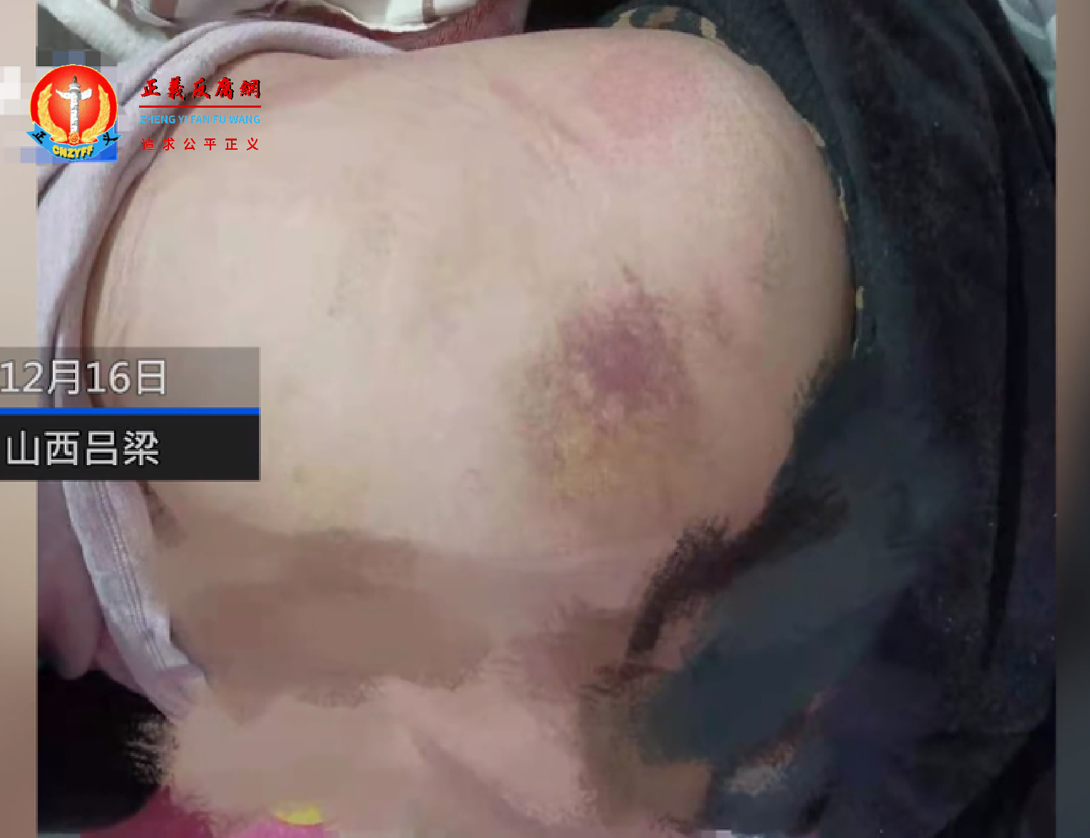 13岁女生小娟（化名）遭校长暴打浑身多处淤青.png