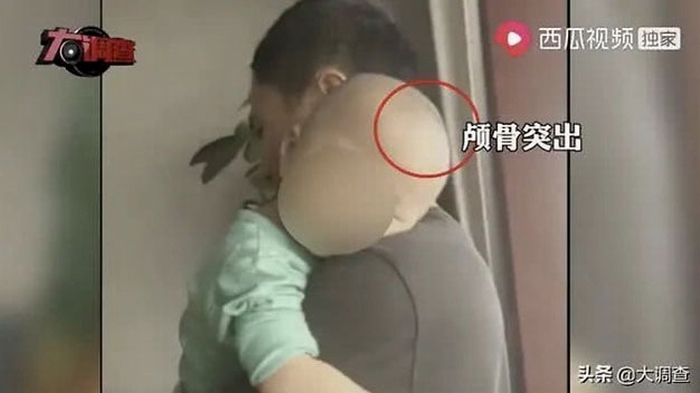 一位患儿饮用假奶粉后，颅骨突出，头部变大，俗称“大头娃娃”。（视频截图.jpg