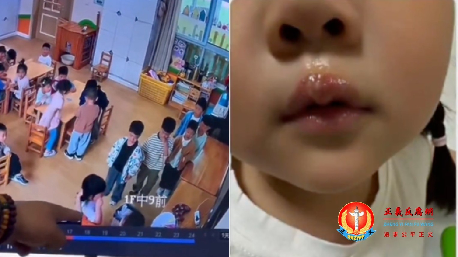 江苏徐州丰县一家幼儿园曝出教师虐童事件，一名女童被教师用热熔胶枪烫伤嘴唇。.jpg